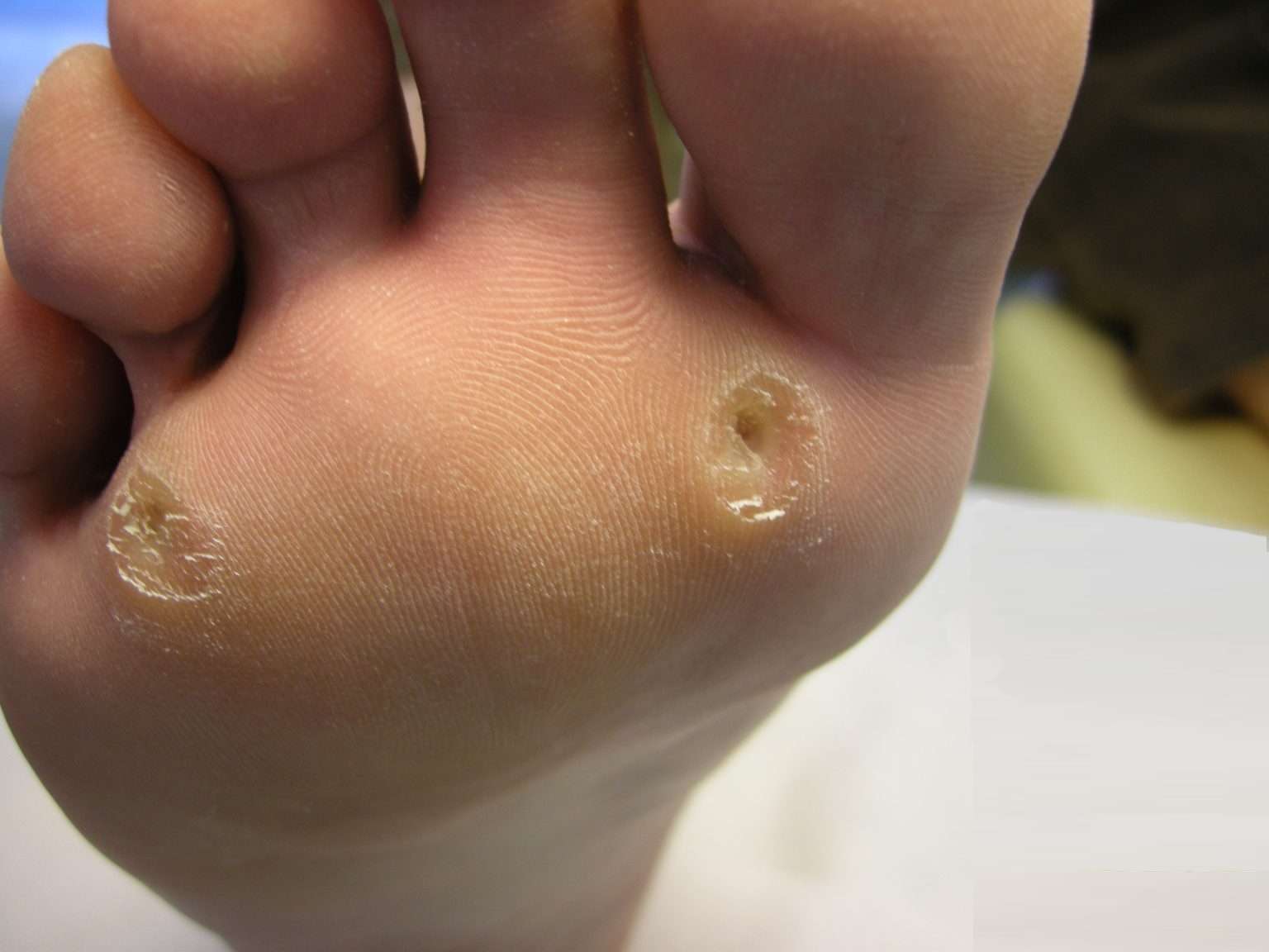 Queratosis Plantar Intratable cpsalud.com